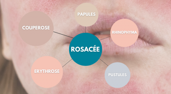 Rougeurs au niveau des joues, du nez  ? Et si c’était de la rosacée  ? 